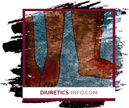 Diuretics for puffiness